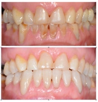 Rehabilitación de arcada inferior en paciente con bruxismo