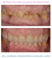 Rehabilitación oclusal