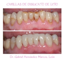 Carillas de di silicato de litio