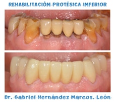 Galería de tratamientos Clínica Renueva dental 