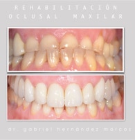 Rehabilitación oclusal de arcada superior