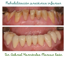 Rehabilitación oclusal de arcada superior