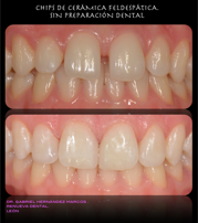 Chips de cerámica feldespática sin preparación dental