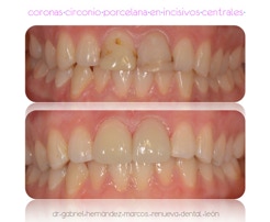 Coronas de circonio porcelana en incisivos superiores centrales