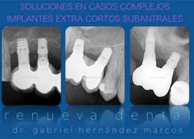 implantes extra cortos en arcada superior