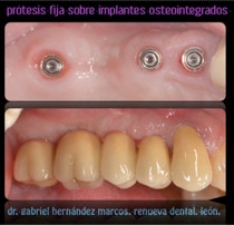 Prótesis fija sobre implantes