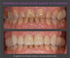 Rehabilitación oclusal de arcada superior