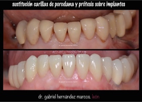 Sustitución estética de carillas de porcelana